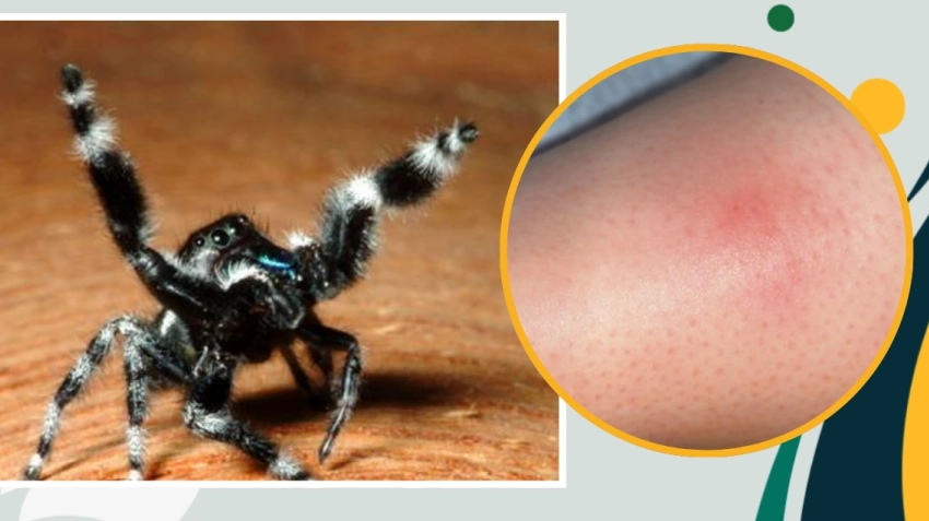 jumping spider bite treatment
